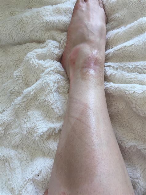 Third Degree Burn Scars