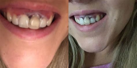 White Spots On Gums From Teeth Whitening at Mary Dement blog