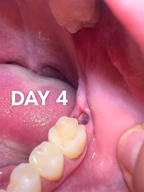 Molar extraction day 4 : r/dentists_ask