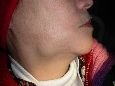 Ganglios Linfáticos Metastásicos ‣ Causas, Signos Y Síntomas - GSJWXX