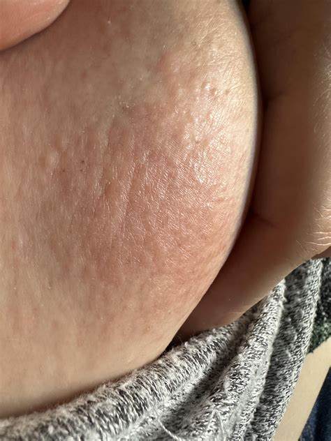 Itchy and scaly skin on my breast. : r/DiagnoseMe