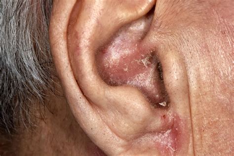Seborrheic Dermatitis Ear