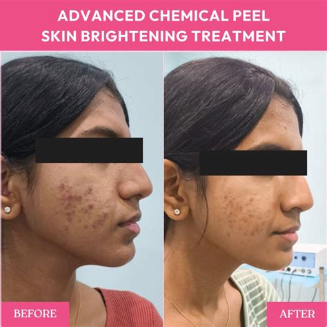Chemical Peel Before and After Transform Your Skin