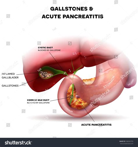 Gallstones Gallbladder Acute Pancreatitis Anatomy Bright Stock Vector ...