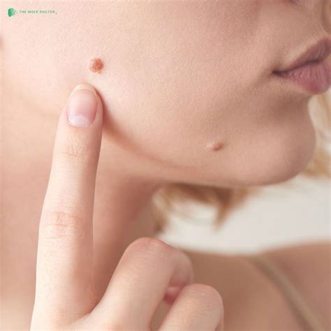 Facial moles come in all shapes, sizes, and textures—but no matter their appearance, The Mole ...