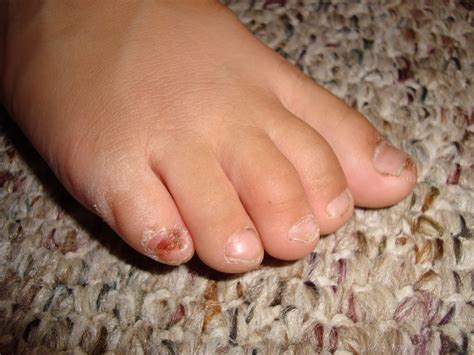 Top of feet itch at night - stormbanana