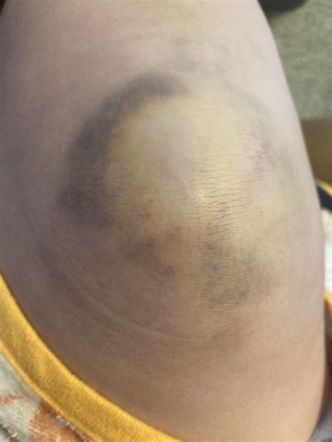 First skating bruises! : r/Rollerskating