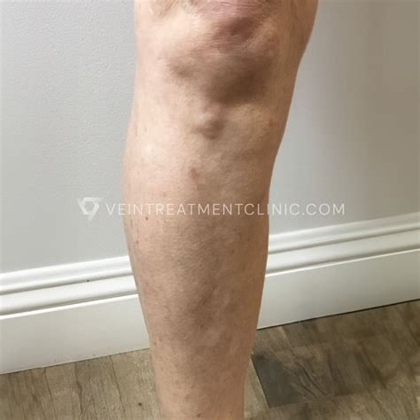 What Are Varicose Veins? | Definition, Causes & Meaning | Vein ...