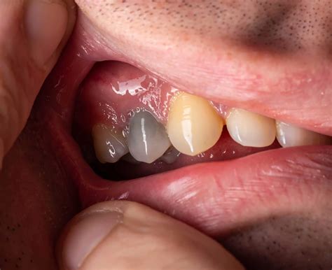 Dead Tooth: Causes, Symptoms, and Treatments | Oral-B