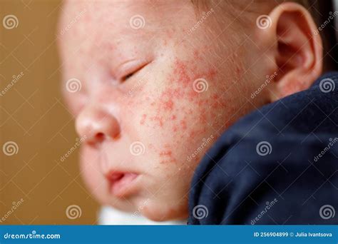 Newborn With Pimples at Wesley Simmons blog