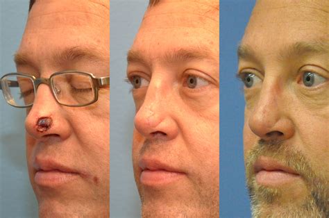 Basal Cell Carcinoma Nose Before And After Pictures at Taj Jessop blog