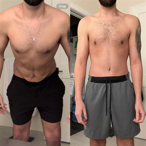 Male - 28 - Lower Body Lift (aka extended or 360 tummy tuck.) : r/tummytucksurgery