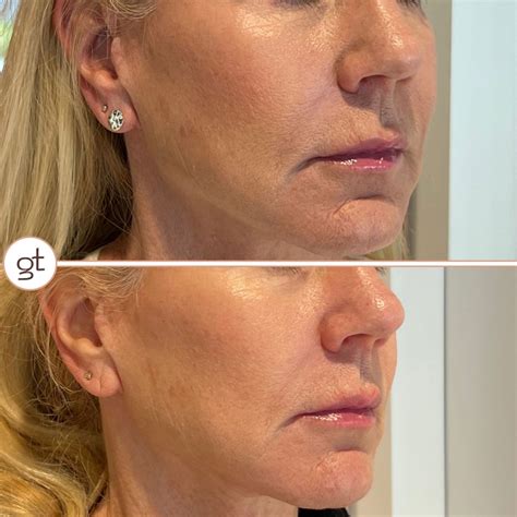 Before and After Gallery Dermal Fillers - Stunning Transformations