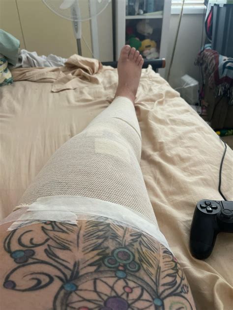 I had surgery on Tuesday- meniscus repair and quad to fix acl. Is it normal to be in this much ...