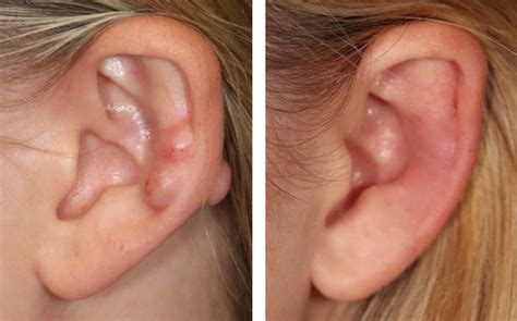 Keloid Ear Keloid Scars Treatment Glasgow | Keloid Scars Removal