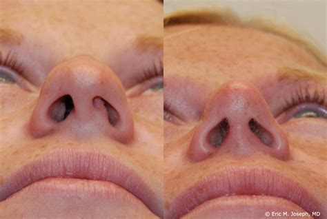 Nose Job With Deviated Septum at Naomi Marshall blog