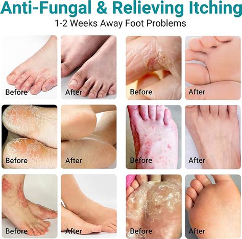 LMNOOP Athletes Foot Treatment Cream Maximum Strength - Antifungal Foot ...