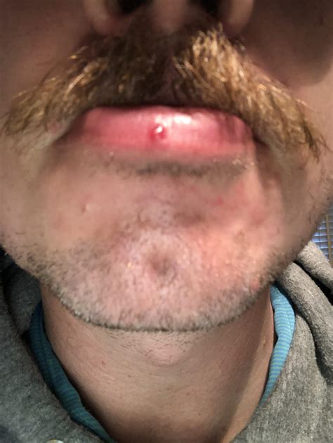 I tried to pop a blackhead on my lip and it turned into this : r ...