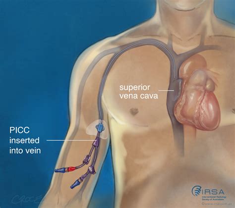 Picc Line Insertion