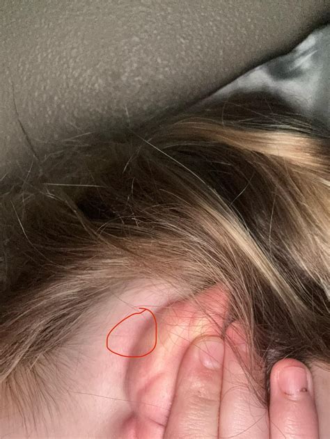 Very Small, Hard round Lump behind ear, under the skin 100% not a ...