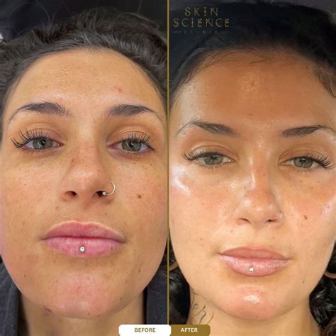 MOXI Laser Treatment - Skin Science Clinic