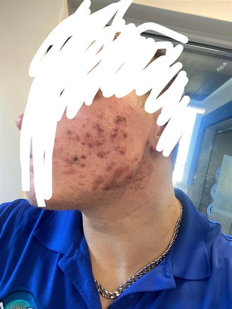 Anyone use Tretinoin on stretch marks??? : r/tretinoin