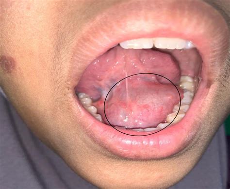 Bumps On Back Of Throat