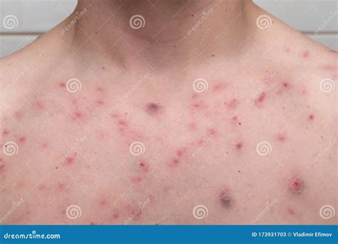 Chest Acne Causes Male at Marcus Riedel blog