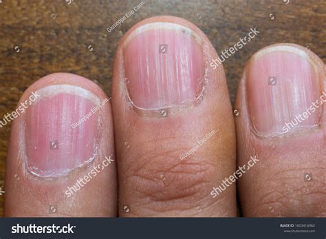 Vertical Ridges On Fingernails Symptoms Deficiency Stock Photo ...