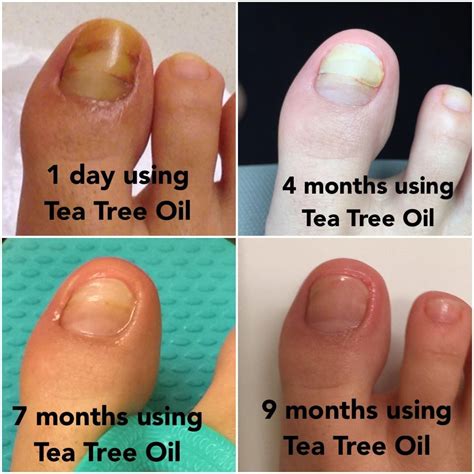 Tea Tree Oil For Nail Fungus | Nail Designs