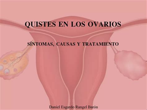 Daniel Esgardo Rangel Barón - Quistes en los ovarios, síntomas, causas y tratamiento | PPTX