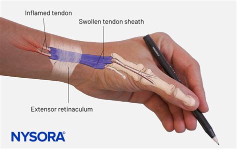 Patient Case Study: De Quervain’s Tenosynovitis - Injection - NYSORA