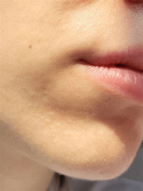 What is this? White bumps on chin. : r/DermatologyQuestions