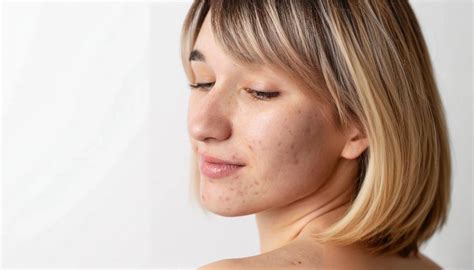 What is Post-Inflammatory Hyperpigmentation – Skin To Heart