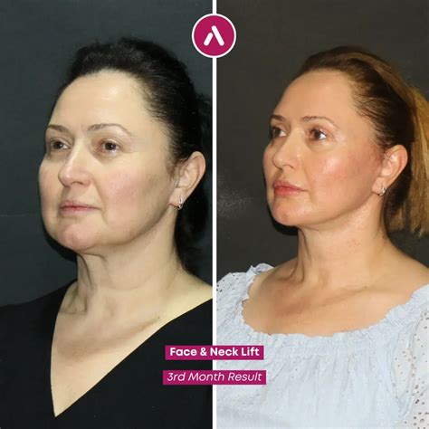 Deep Plane Facelift Istanbul: AKM Clinic Patient Testimonial