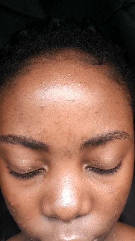 I got these acne scars 4 months ago when I started using retinol, and they haven't gone. does ...