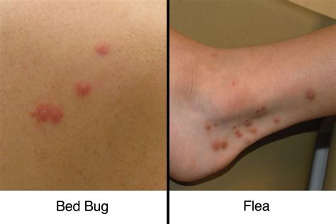 What Do Bed Bug Bites Look Like Up Close at Michael Dittmer blog