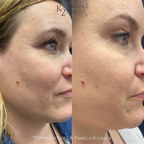 Microneedling with SkinPen | #1 FDA Approved | Birmingham, AL