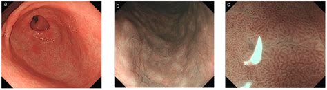 Endoscopic Grading of Gastric Intestinal Metaplasia Using Magnifying and Nonmagnifying Narrow ...