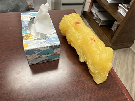 What 5 pounds of fat looks like : r/Mounjaro