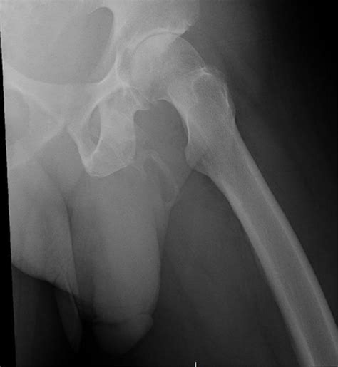 Doctors Take Hip X-Ray, Discover Patient's Penis Is Literally Turning to Bone : ScienceAlert
