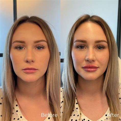 Lip Fillers Before and After: A Comprehensive Guide to Stunning Results