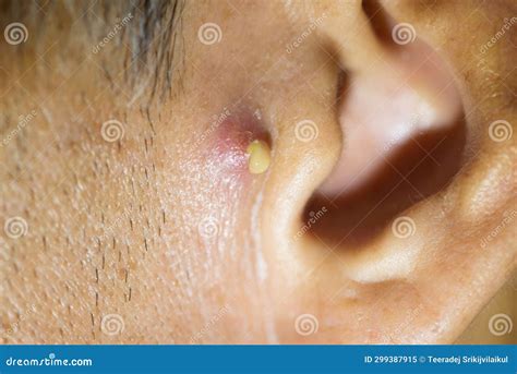 Pus Coming from Nodular Cystic Acne in Front of the Man Ear Stock Image ...