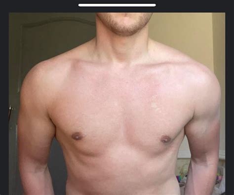 Examples of gyno surgery scars from plastic surgeon Michael Law MD : r/gynecomastia