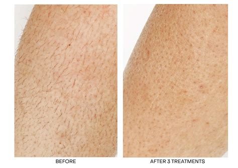 Laser Hair Removal Legs Before And After