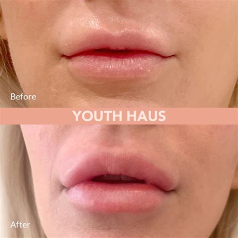 Botox Lips Results at Andrea Mcclelland blog