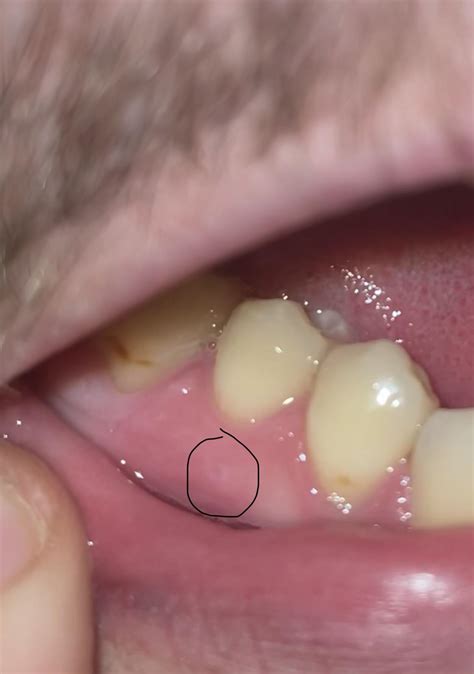 Painless small bump on gums, should I be concerned? : r/askdentists