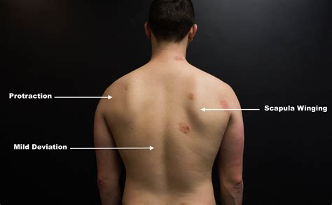 Pain Under Right Scapula