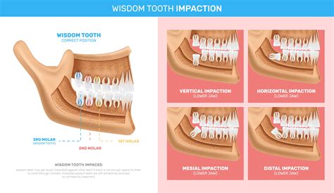 Impacted Wisdom Teeth Pain