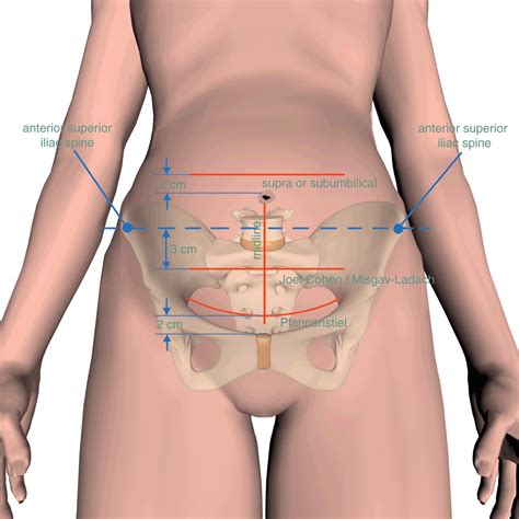 Cesarean Section Incision Types